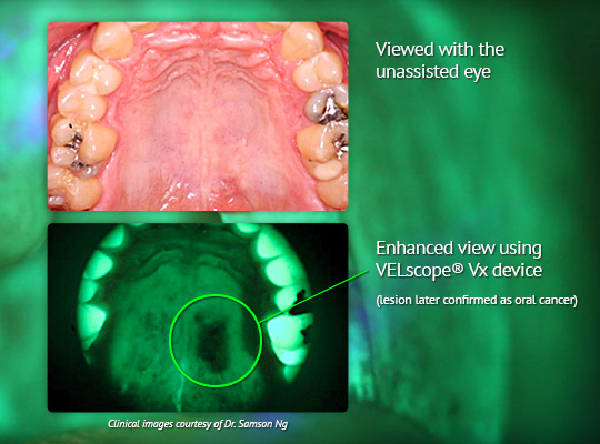 Enhanced view using VELscope Vx device